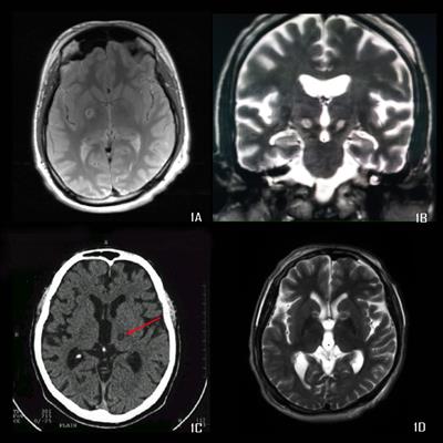 Radiofrequency Lesioning for Movement and Psychiatric Disorders-Experience of 107 Cases